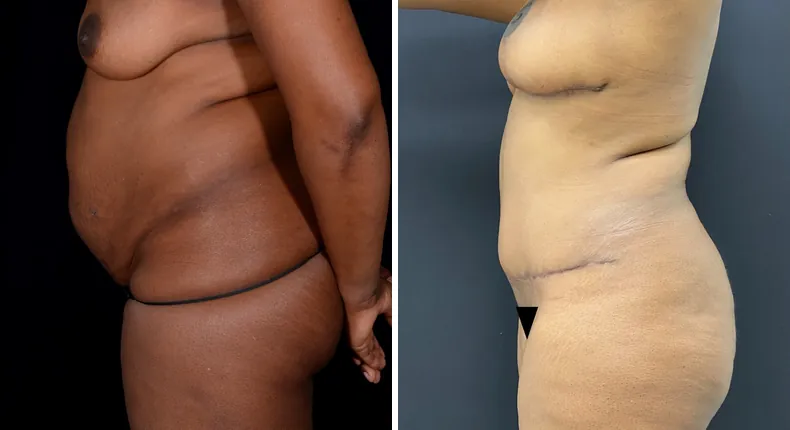 Before and after mommy makeover: patient's body from the left side