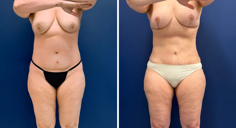Before and after mommy makeover: woman's body, with breast lift, tummy tuck and liposuction