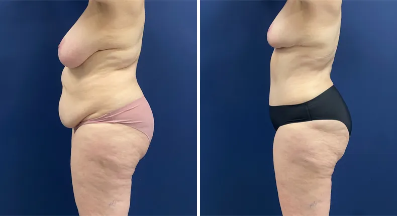 Before and after mommy makeover: patient's body from the left side