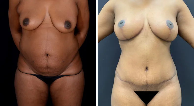 Before and after mommy makeover: patient's body from the front