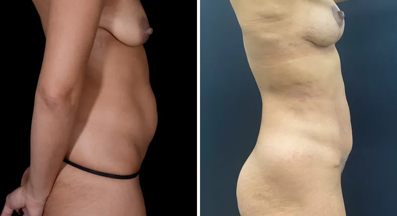 Before and after mommy makeover: woman's body from the right side