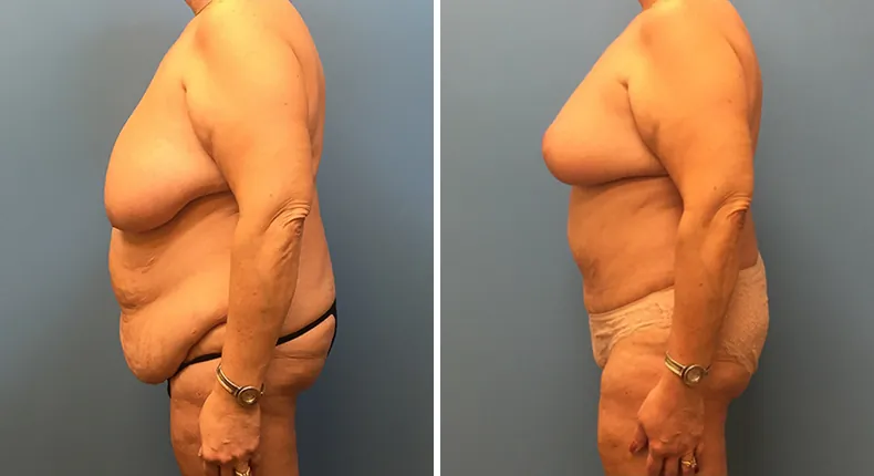Before and after mommy makeover: woman's body from the left side