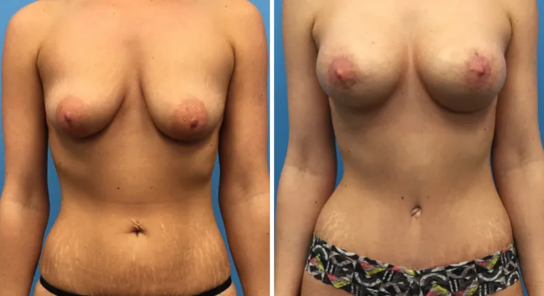 Before and after mommy makeover: woman's body from the front