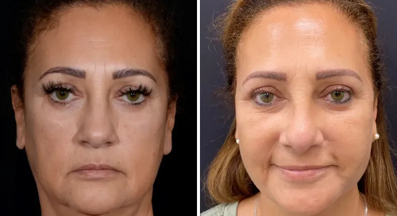 Before and after neck lift: patient's neck from the front, with facelift, Face360 and rhinoplasty