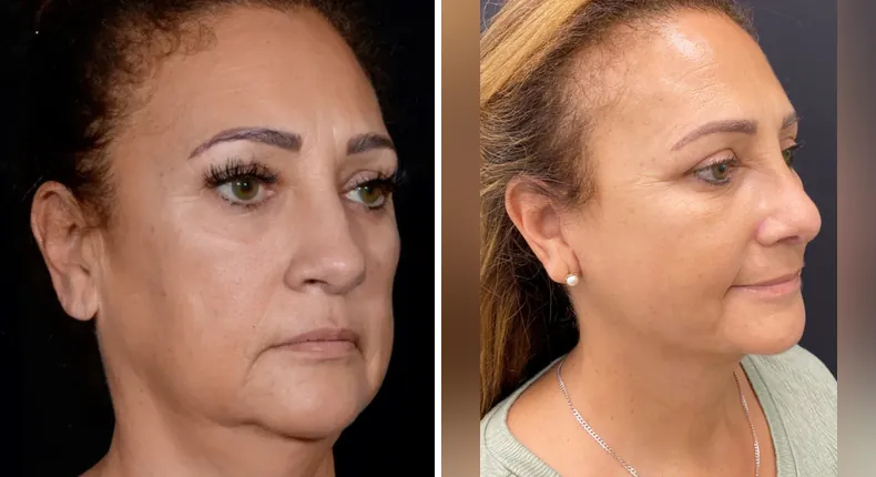 Before and after neck lift: patient's neck at a right angle, with facelift, Face360 and rhinoplasty