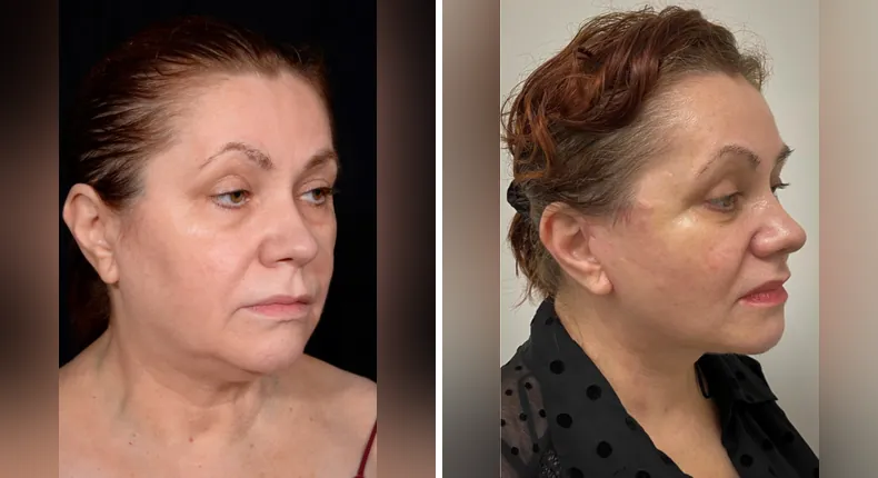 Before and after neck lift: patient's neck at a right angle, with facelift, brow lift, eyelid surgery, facial fat grafting and Face360