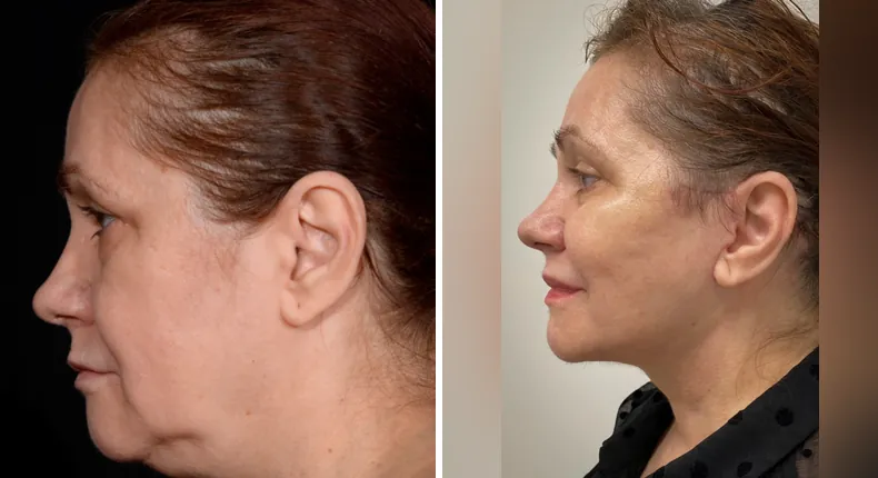 Before and after neck lift: patient's neck in left profile, with facelift, brow lift, eyelid surgery, facial fat grafting and Face360