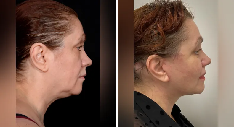 Before and after neck lift: patient's neck in right profile, with facelift, brow lift, eyelid surgery, facial fat grafting and Face360