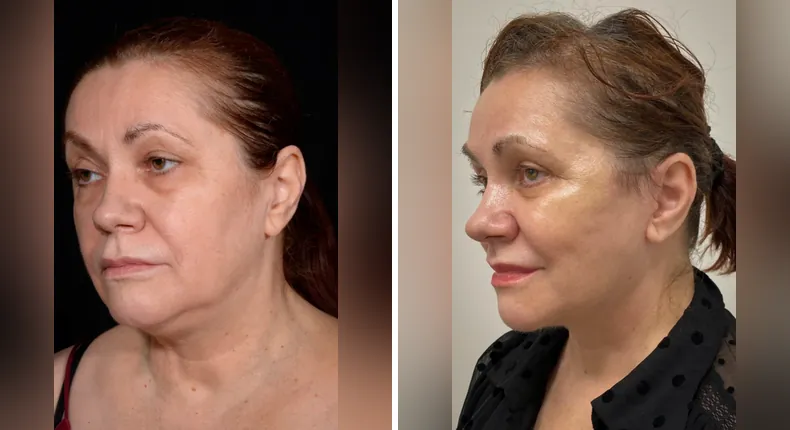 Before and after neck lift: patient's neck at a left angle, with facelift, brow lift, eyelid surgery, facial fat grafting and Face360