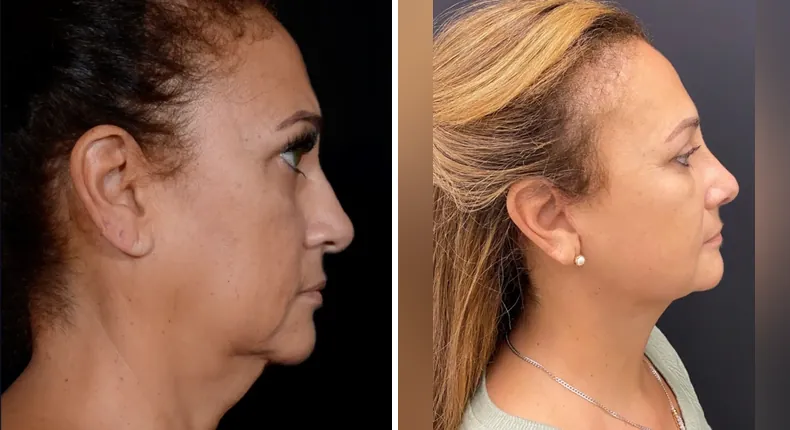 Before and after neck lift: patient's neck in right profile, with facelift, Face360 and rhinoplasty