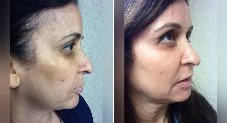 Before and after non-surgical: patient's face in right profile, with skin care