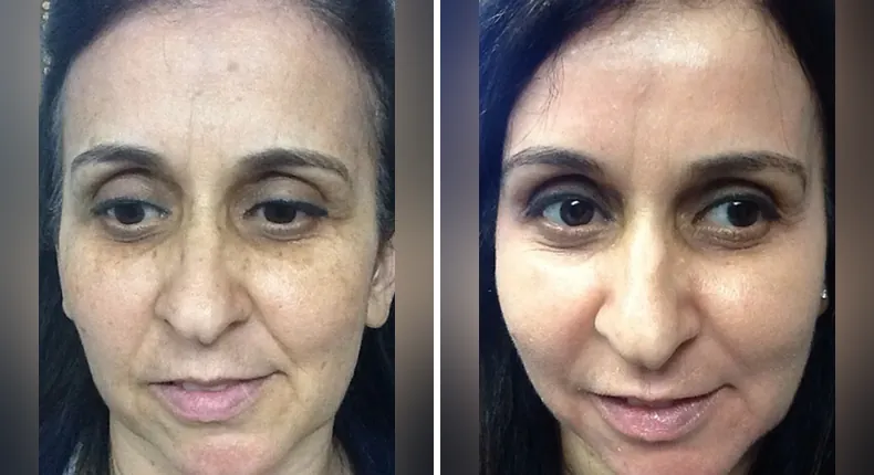 Before and after non-surgical: patient's face from the front, with skin care