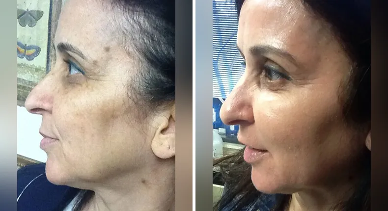 Before and after non-surgical: patient's face in left profile, with skin care