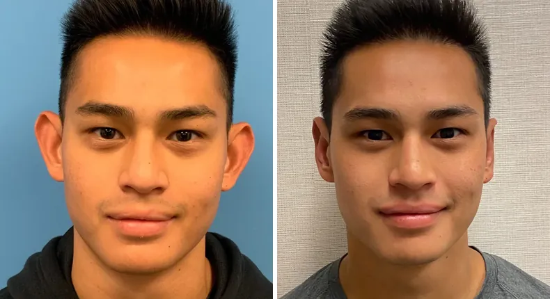 Before and after otoplasty: patient's ears from the front