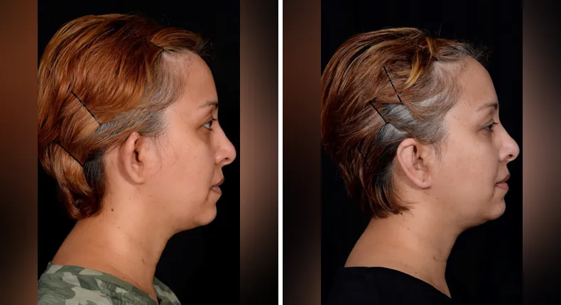 Before and after otoplasty: patient's ears in right profile