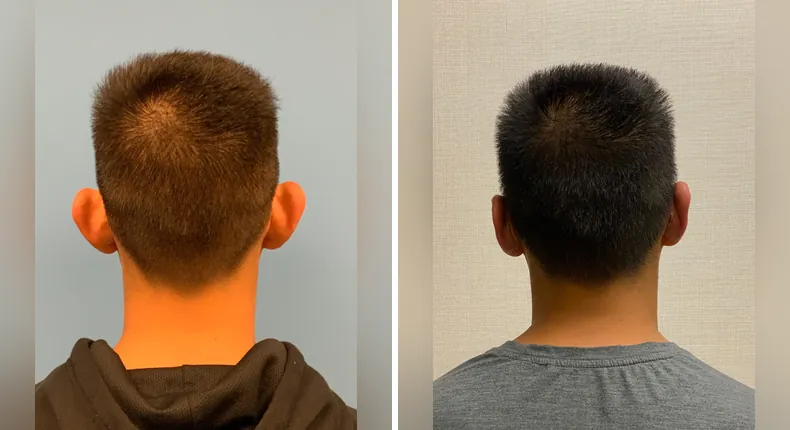 Before and after otoplasty: patient's ears from the back