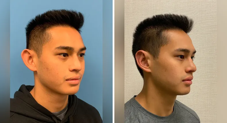 Before and after otoplasty: patient's ears at a right angle