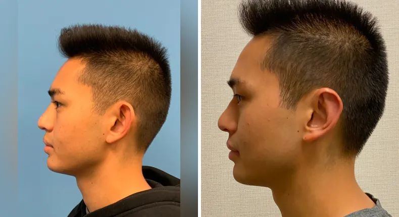 Before and after otoplasty: patient's ears in left profile