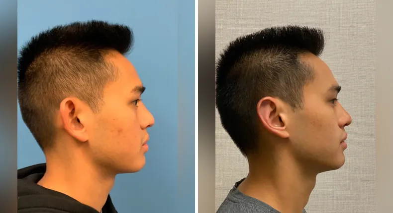 Before and after otoplasty: patient's ears in right profile