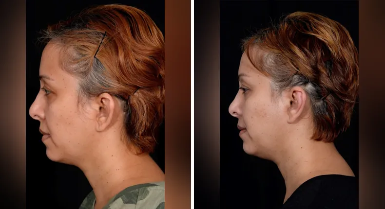 Before and after otoplasty: patient's ears in left profile