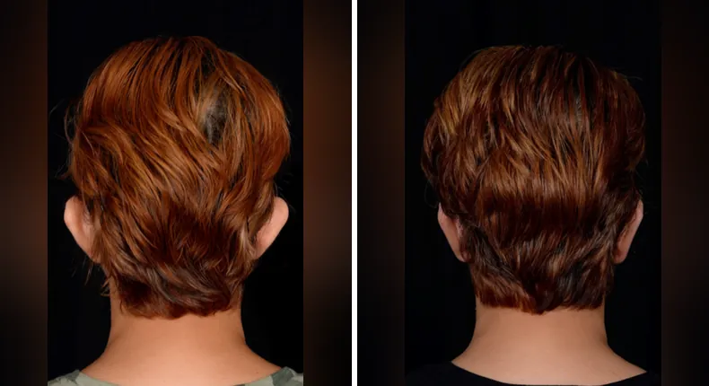 Before and after otoplasty: patient's ears from the back