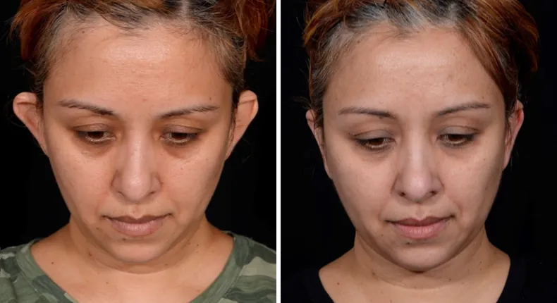 Before and after otoplasty: patient's ears from the front