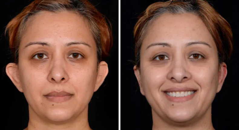 Before and after otoplasty: patient's ears from the front