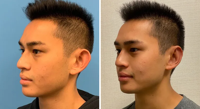 Before and after otoplasty: patient's ears at a left angle