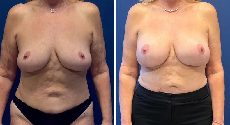 Before and after Preserve Breast Augmentation: woman's breasts