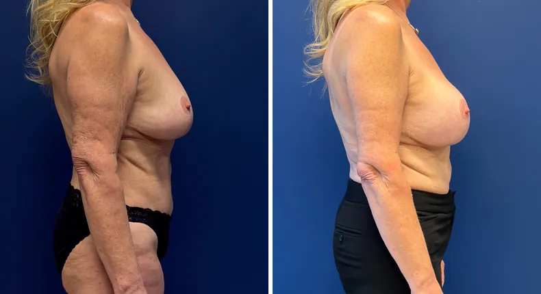 Before and after Preserve Breast Augmentation: woman's breasts