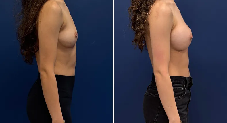 Before and after Preserve Breast Augmentation: patient's breasts