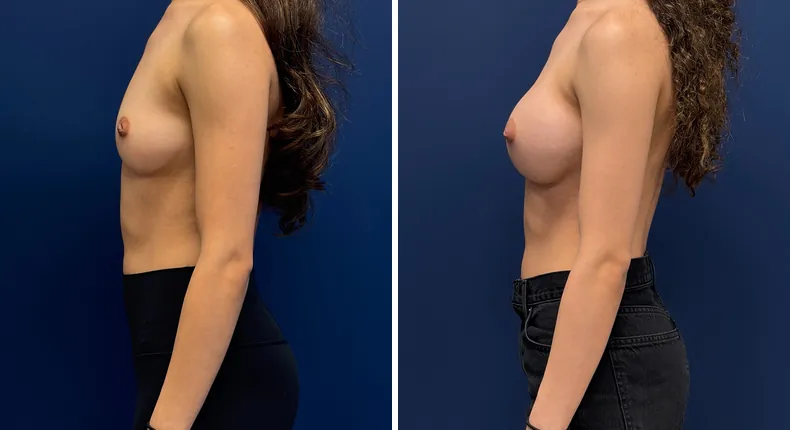 Before and after Preserve Breast Augmentation: patient's breasts