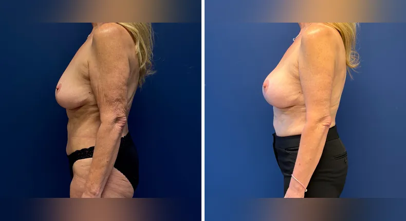 Before and after Preserve Breast Augmentation: woman's breasts