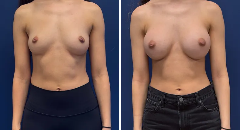 Before and after Preserve Breast Augmentation: patient's breasts