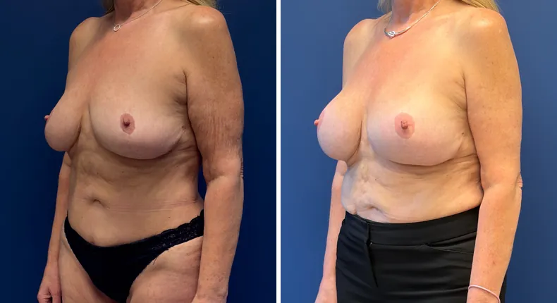 Before and after Preserve Breast Augmentation: woman's breasts