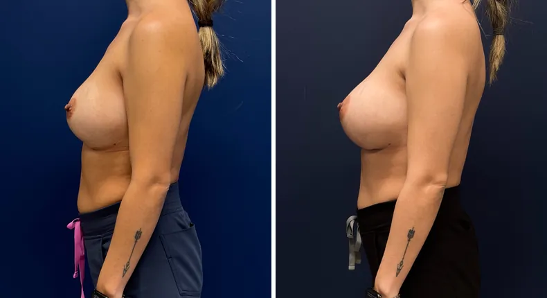 Before and after revision breast augmentation: patient's breasts