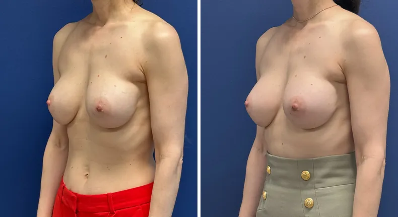 Before and after revision breast augmentation: patient's breasts at a left angle