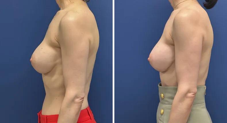 Before and after revision breast augmentation: patient's breasts from the left side