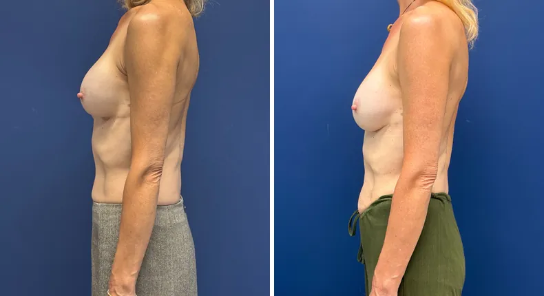 Before and after revision breast augmentation: woman's breasts