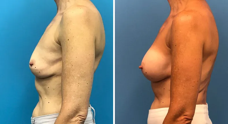 Before and after revision breast augmentation: woman's breasts from the left side