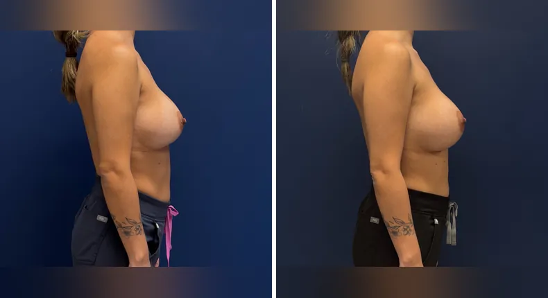 Before and after revision breast augmentation: patient's breasts