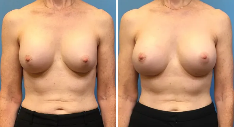 Before and after revision breast augmentation: patient's breasts