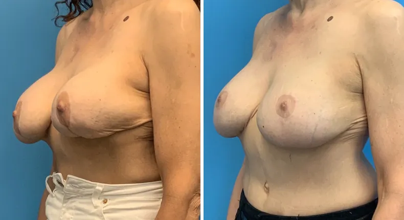 Before and after revision breast augmentation: patient's breasts at a left angle