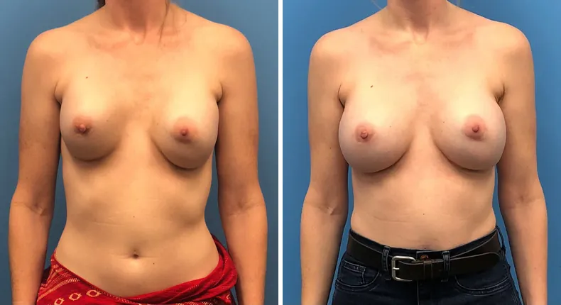 Before and after revision breast augmentation: woman's breasts from the front