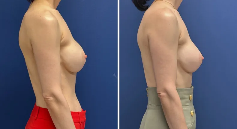 Before and after revision breast augmentation: patient's breasts from the right side