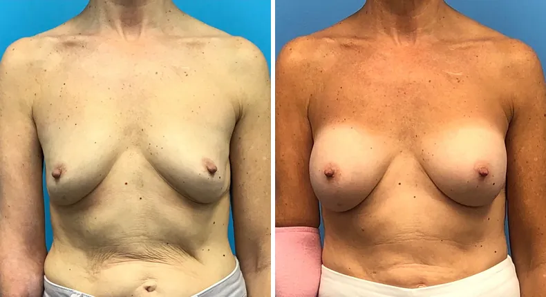 Before and after revision breast augmentation: woman's breasts from the front