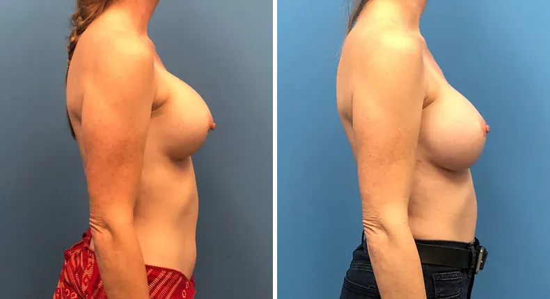 Before and after revision breast augmentation: woman's breasts in right profile