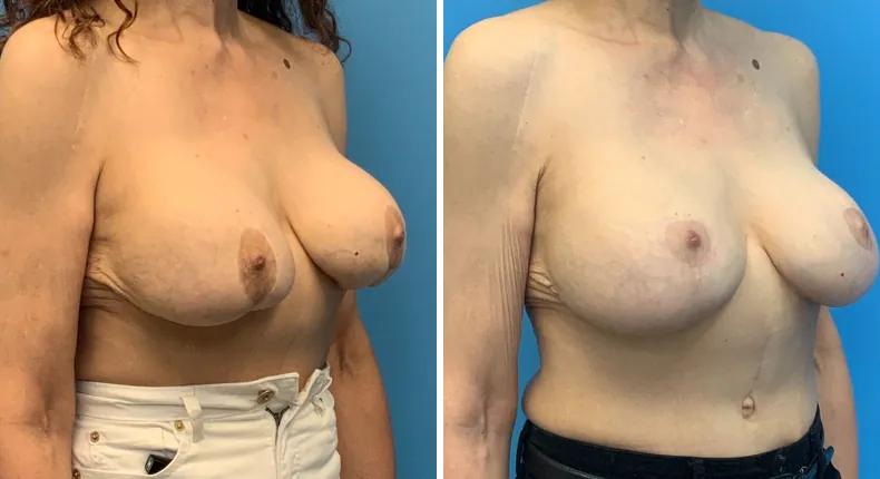 Before and after revision breast augmentation: patient's breasts at a right angle