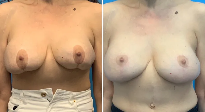 Before and after revision breast augmentation: patient's breasts from the front