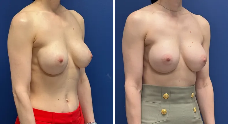 Before and after revision breast augmentation: patient's breasts at a right angle